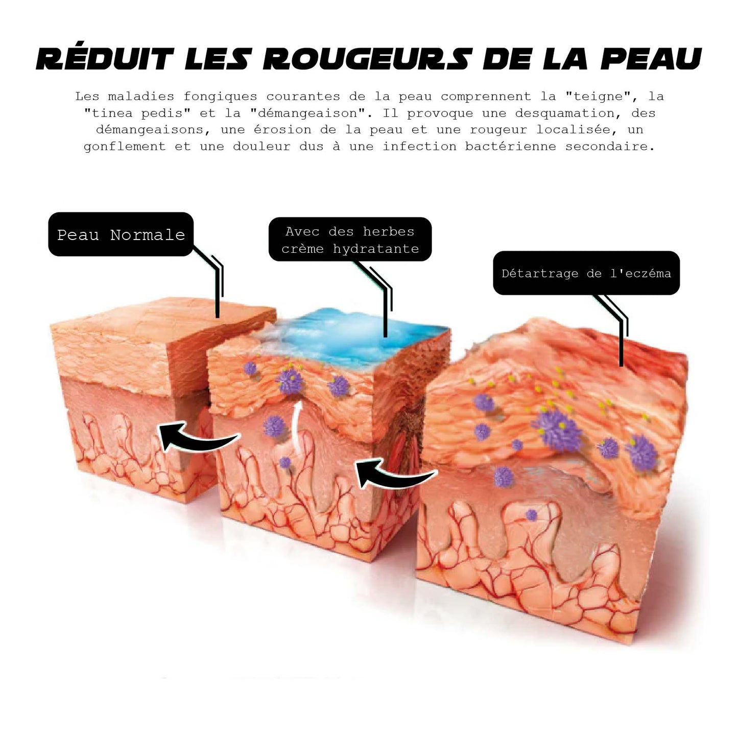 ATTDX AthlètesPieds Soulagement des champignons TraitementPulvérisation