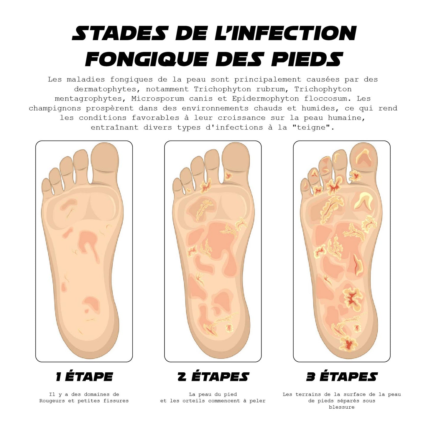 ATTDX AthlètesPieds Soulagement des champignons TraitementPulvérisation