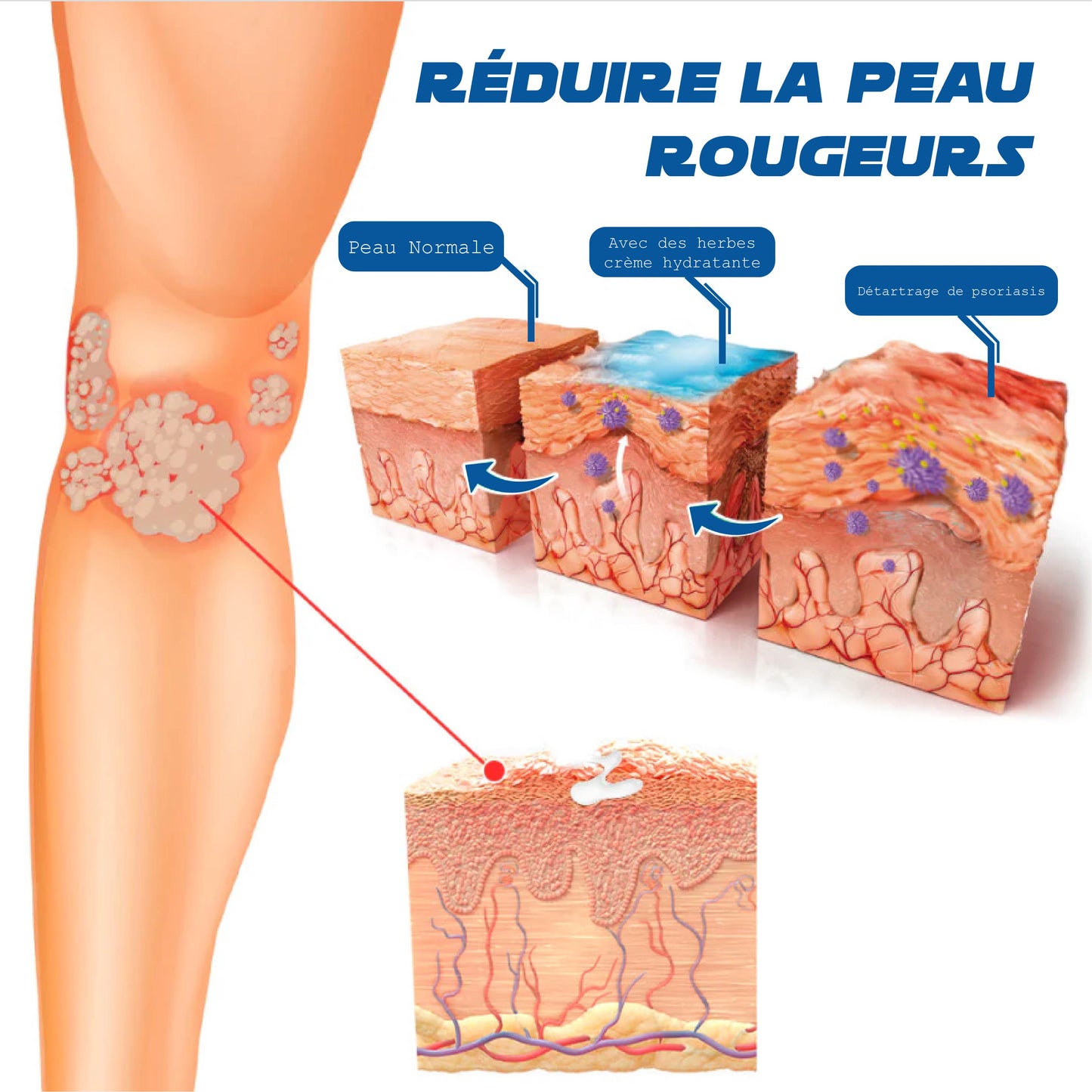 ATTDX Psoriasis Traitement AbeilleVenin Crème