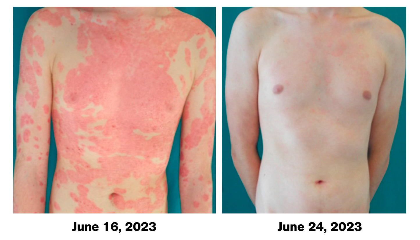 ATTDX Psoriasis Traitement AbeilleVenin Crème