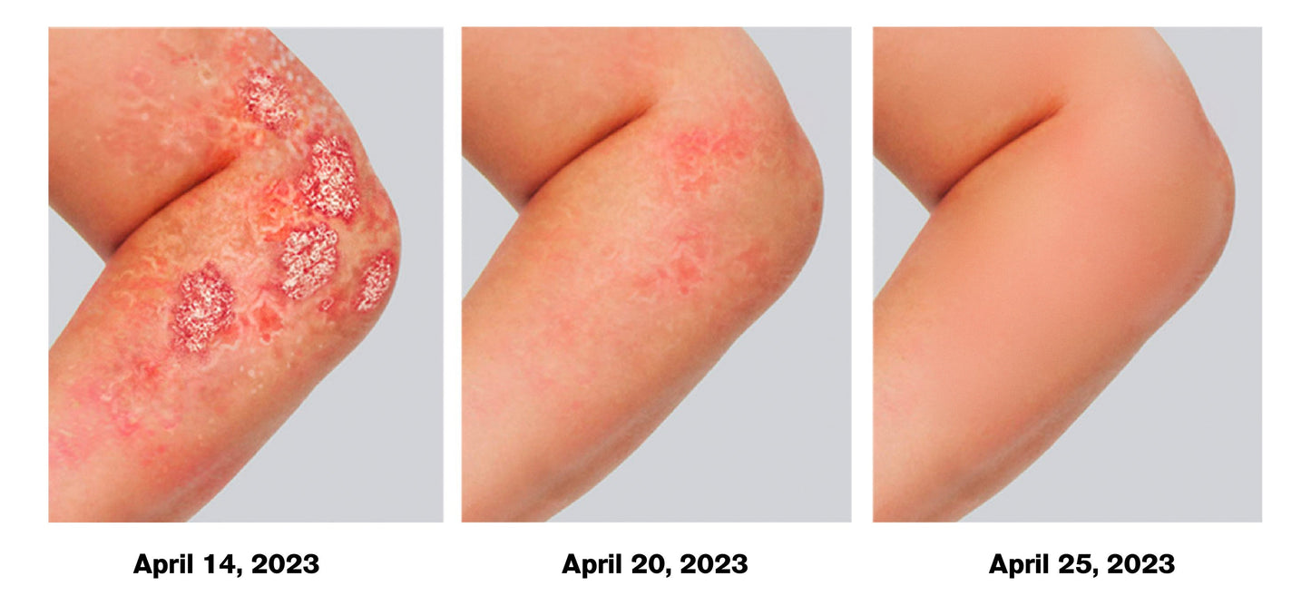 ATTDX Psoriasis Traitement AbeilleVenin Crème